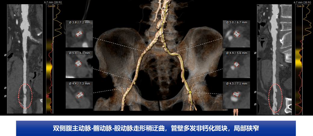 吉林大学白求恩第一医院完成一例腋动脉入路横位心高难度tavr手术