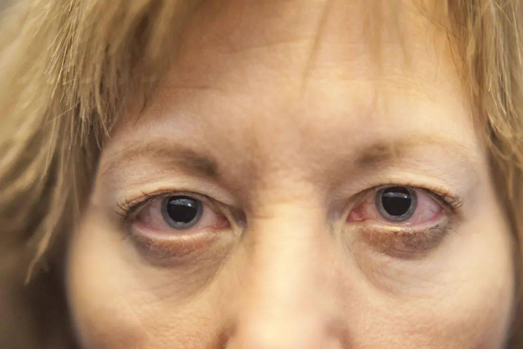 得了青光眼有哪些症状呢?