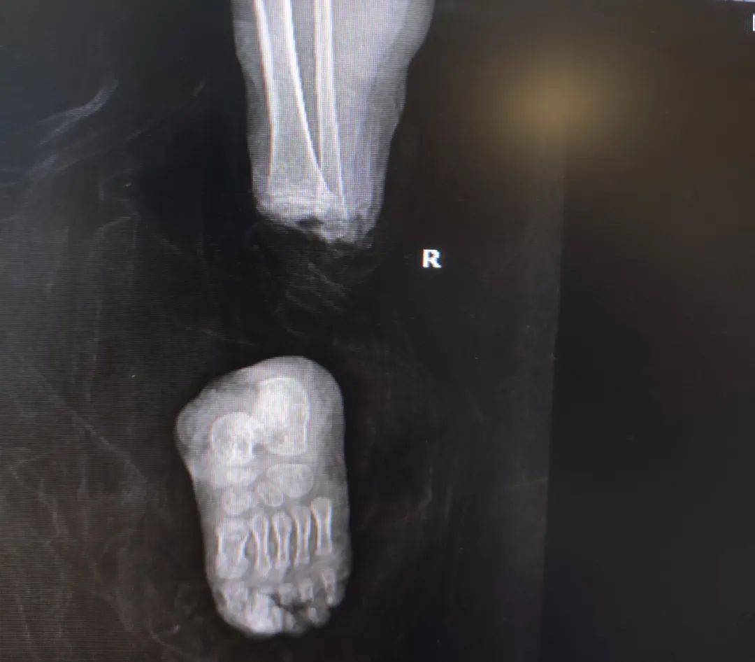 梧州2岁7个月的小莹被意外砍断了右脚,并完全分离!情况紧急.