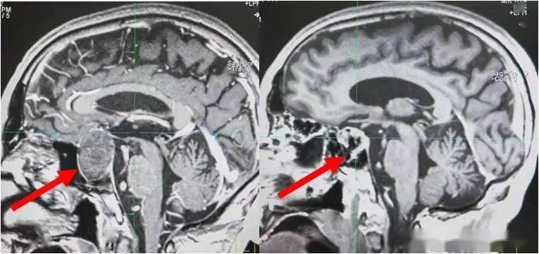 团队|北京协和医院多学科团队紧急采用术中MRI，让垂体瘤卒中患者重获光明