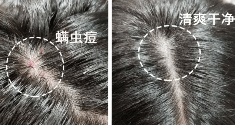 头皮头屑暴增？头皮扣下“白泥”？用Ta,帮你揪出头屑“内鬼”！清爽柔顺，发量翻一番！