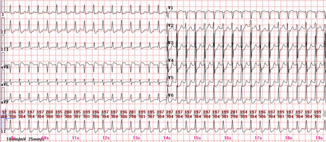 室上性心律心电图特征图片