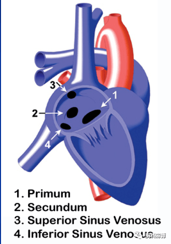 肺动脉_患者_艾森曼格