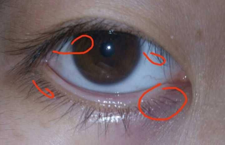 睑缘切口恰巧有个优点,睫毛根部的毛细血管非常丰富,在此位置做切口