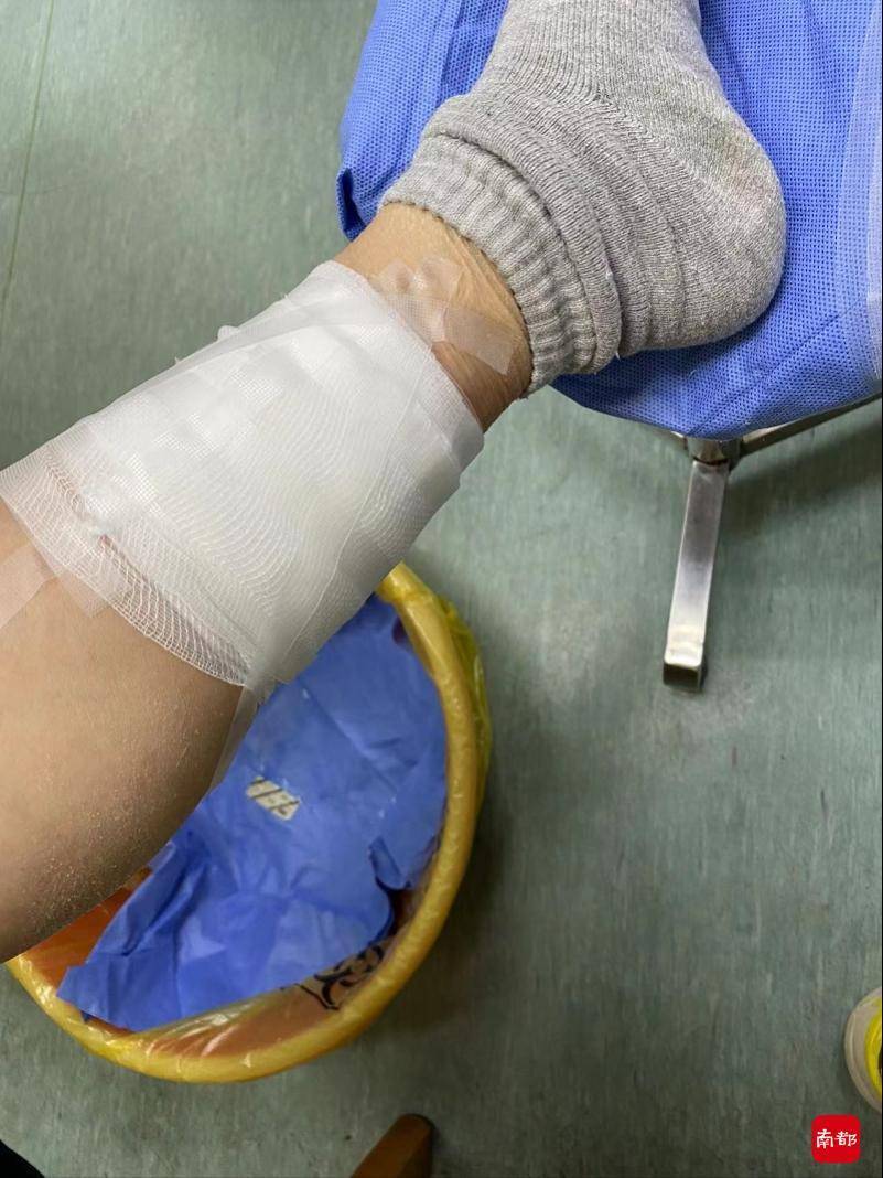 王芳|99元体验艾灸小腿烫了个“洞”，专家：艾灸误用或加重症状