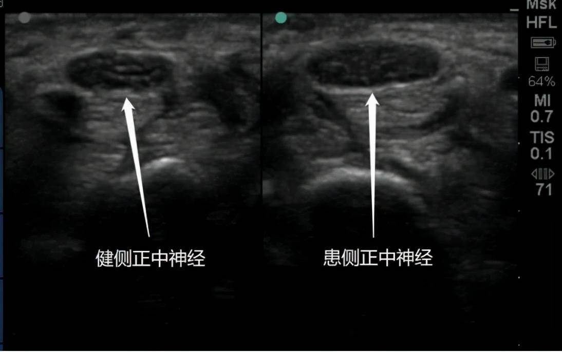 腓总神经超声图图片