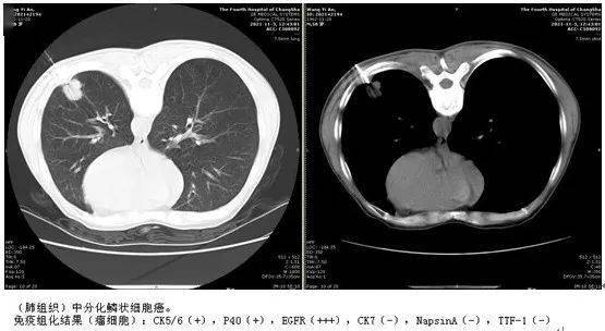 肺结节科普②良性还是恶性别纠结这些手段可以帮你