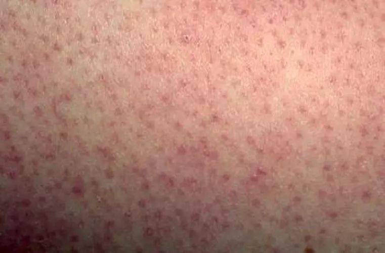 怎么解决胸前的鸡皮肤瘙痒的简单介绍