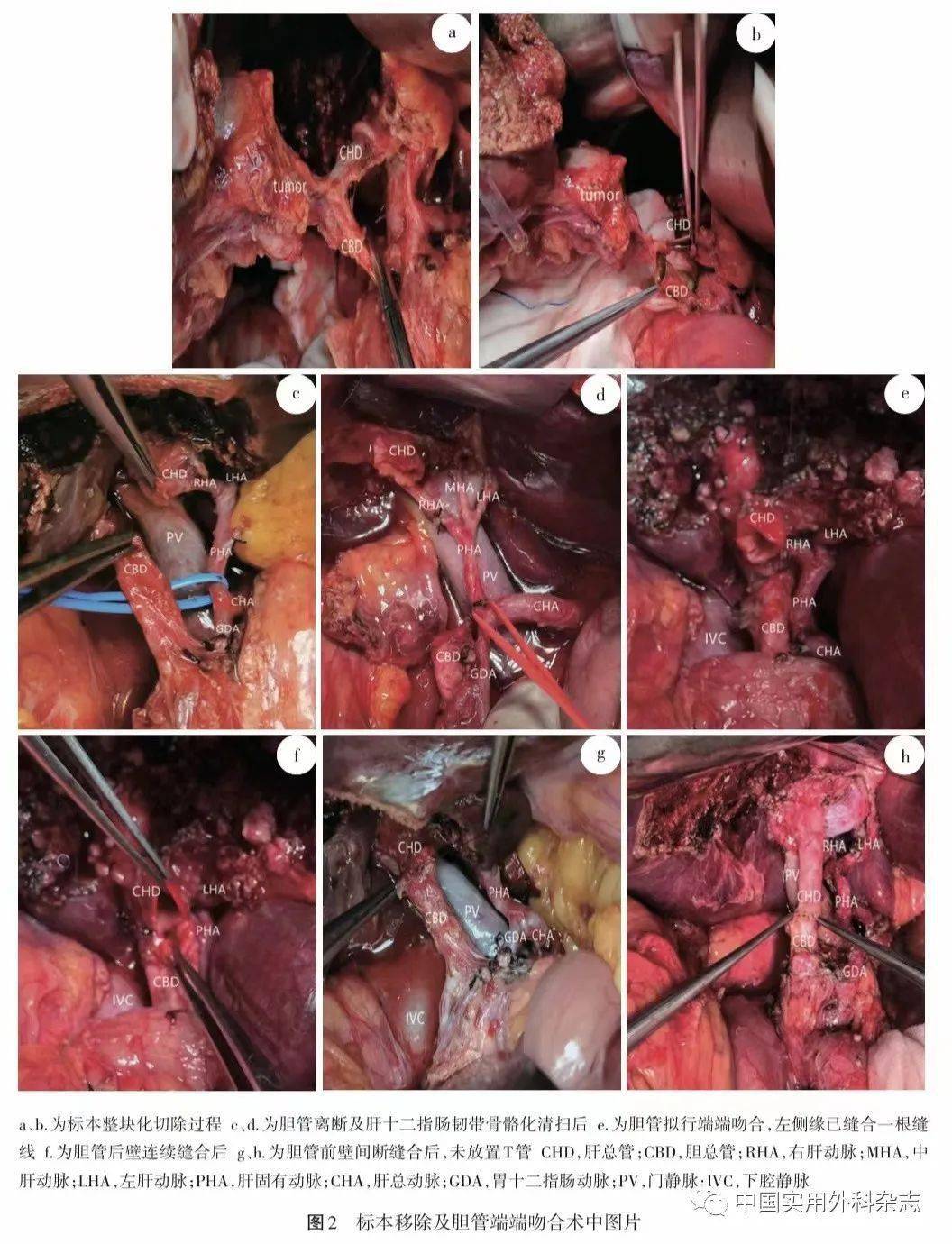 论著胆管t型切除端端吻合在胆囊癌根治术中应用研究