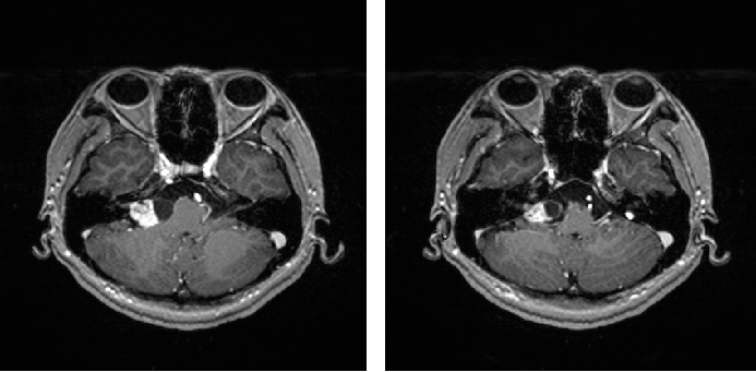 电测听:右 ac21db,bc21db;左 ac18db,bc18db (见图).