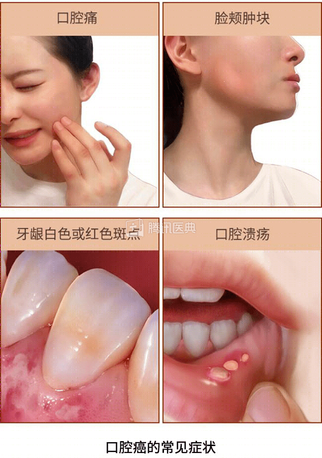 口腔溃疡总是反反复复可能不是小病教你几招区分
