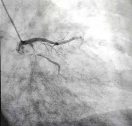 手术|【新闻快递】多学科联动，CCU成功开展EMCO支持下高危冠脉介入手术