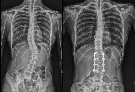 脊柱|17岁女生频频腰痛竟需要手术！因为这件事……