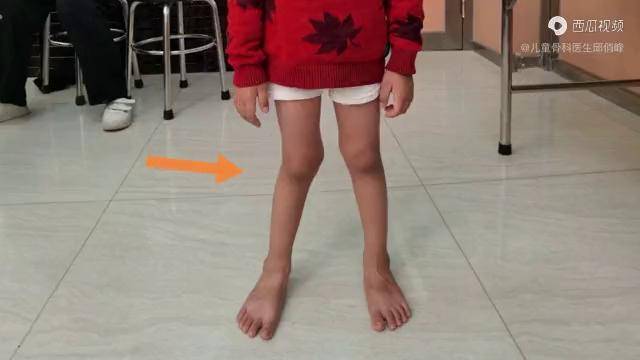 腿的长短发生了改变长期这样走路脊柱也受影响