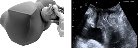 超声残余尿量测量图片图片