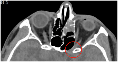 眼部ct:术前视神经管骨折夏先生视野检查结果,黑色表示视野缺损,正常