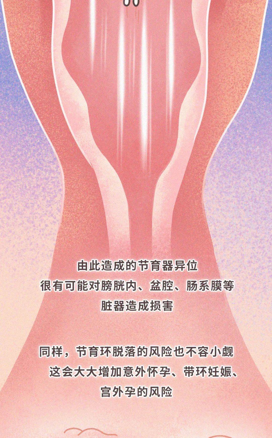 秘密节育环真正的秘密，女性并不知道