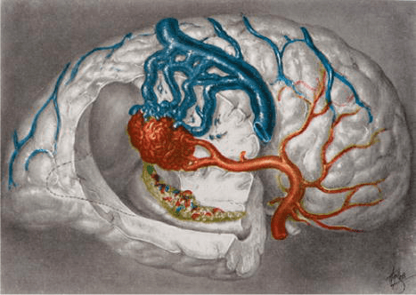 aneurysms )里,他对后循环动脉瘤包括基底动脉尖动脉瘤的外科手术治疗
