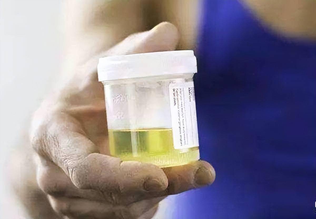 医生:如果有2处发臭,晚上尽量坚持3不要_肾脏_疾病_尿液