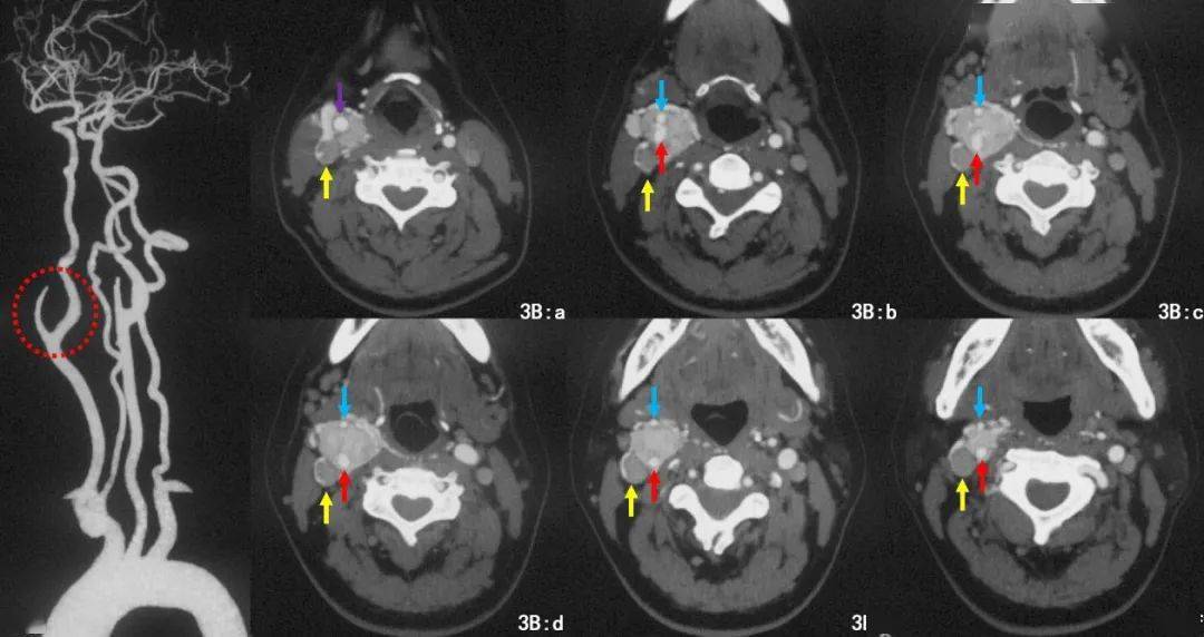 颈动脉体瘤位置图片图片