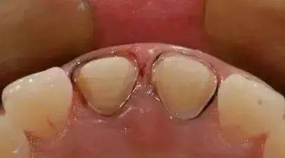 双线排龈的应用_临床_牙龈_体制