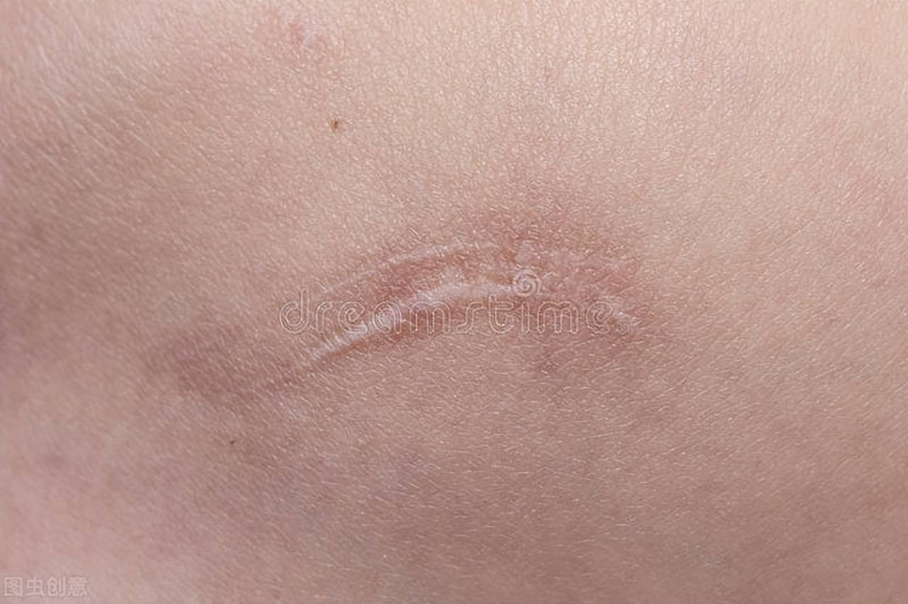 瘢痕体质的瘢痕怎么才能去除疤痕？ - 知乎
