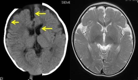 3个月时头部ct,双额顶部蛛网膜下腔增宽,前纵裂7mm,侧脑室略扩张(左图