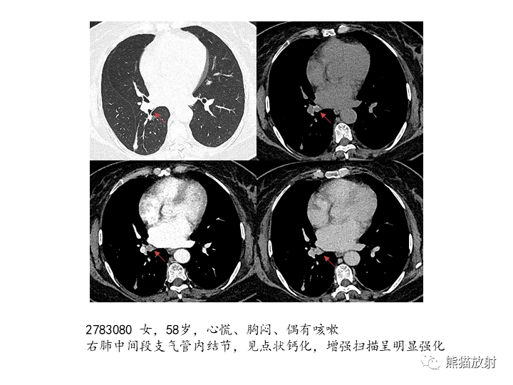 省立影像读片支气管肿瘤2203