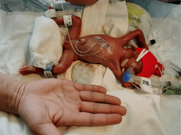体重仅710克,市第一人民医院成功救治一名27周早产儿