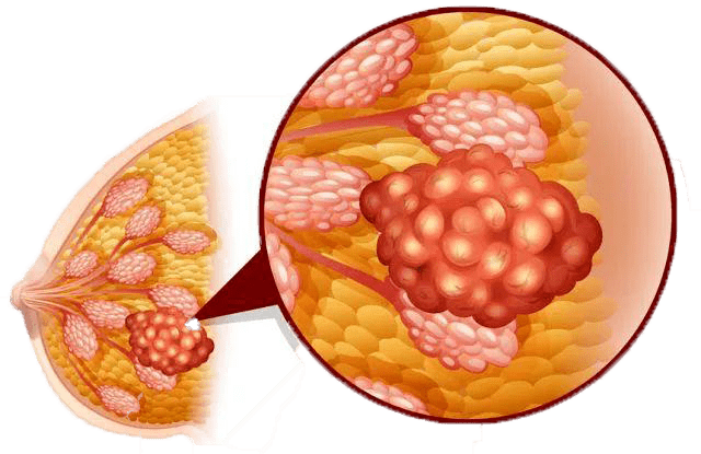 乳腺检查报告单——什么是乳腺的bi-rads分级?