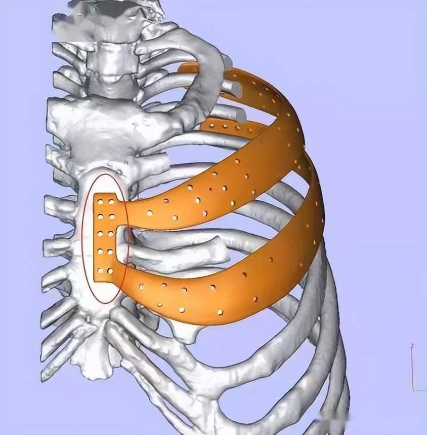 腫瘤侵襲男子胸骨3d打印助其重塑新胸廓