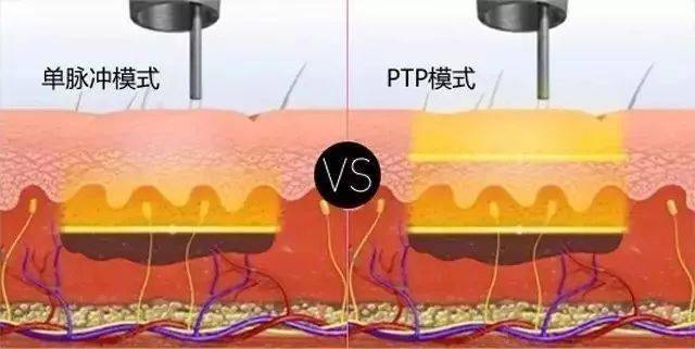 集中的能量及色素选择性,极短的脉宽,使激光能量精准作用于色素颗粒