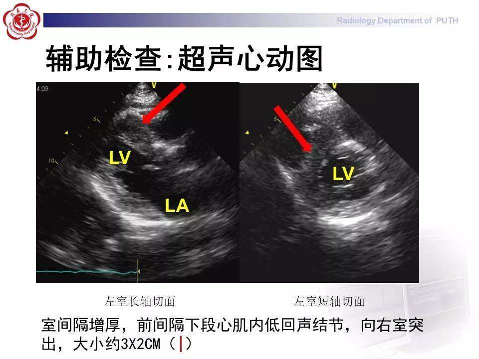 下腔静脉b超的解剖图图片