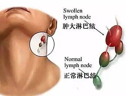 淋巴代謝廢水,廢氣,廢脂,人體全身上下大約有800枚淋巴結,頸部就佔了