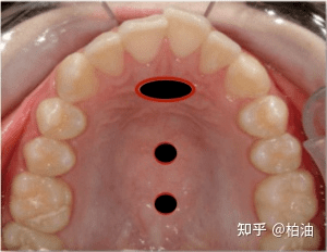 另一种是高舌位,舌头轻轻贴在上颚,舌尖顶在门牙后方的凸起处.