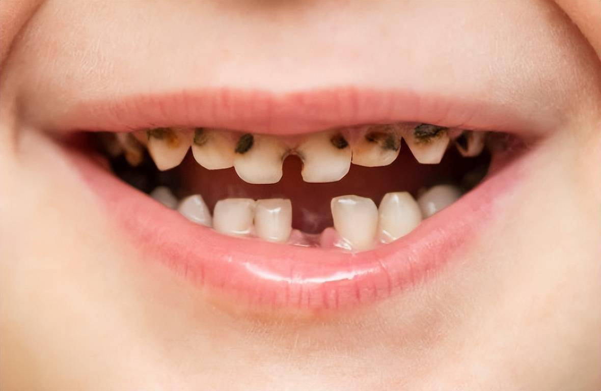 儿童臼齿龋齿图片