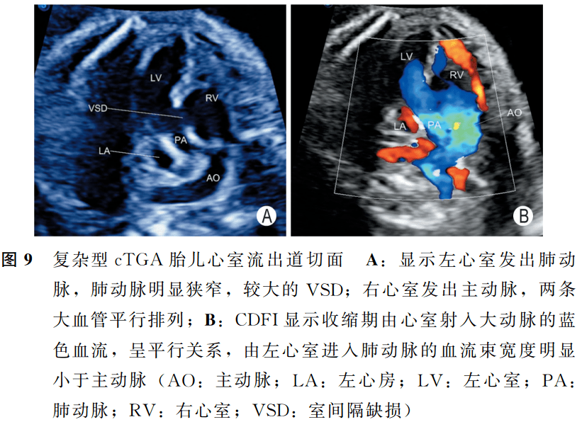庆祝胎儿完全型大动脉转位中孕期超声检查中国专家共识2022版发布