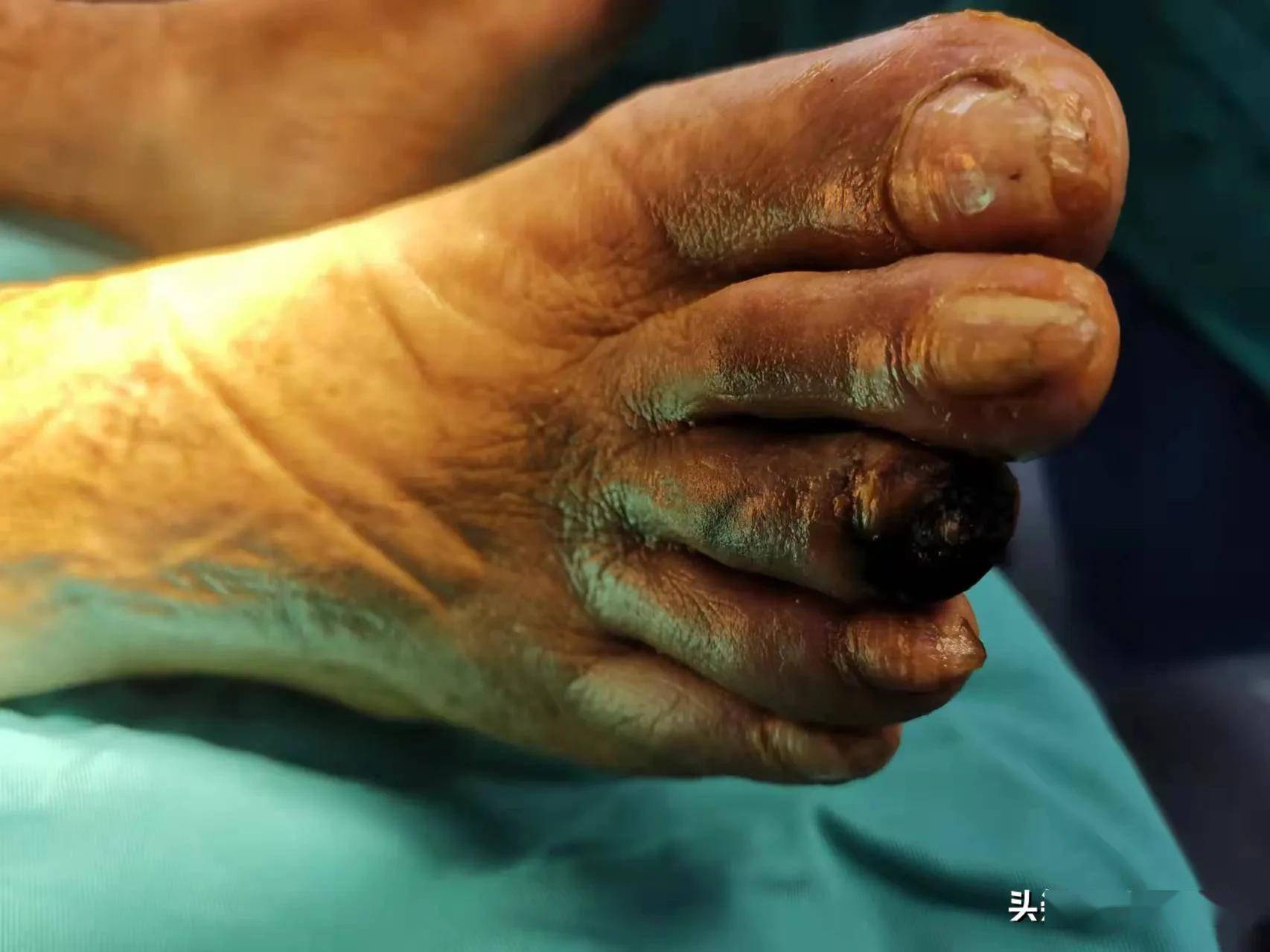 72岁老人患糖尿病30年糖尿病足严重要截肢专家果断手术保住腿