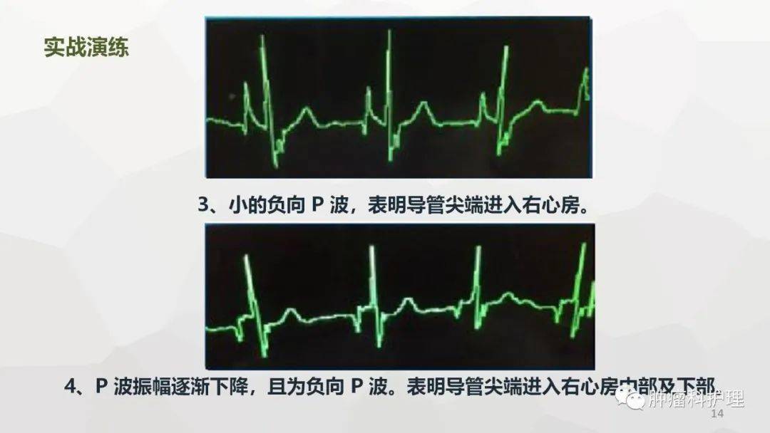 【ppt】腔内心电定位技术在picc置管术中的应用