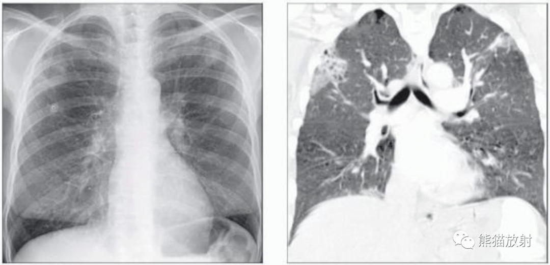 肺孢子菌肺炎卡肺肺寄生虫病丨影像表现