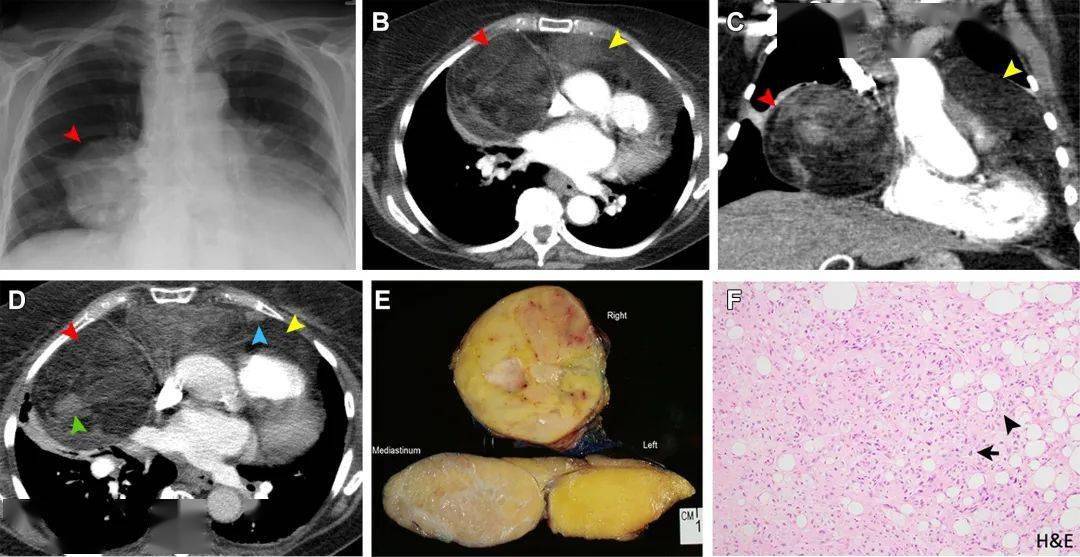 罕见原发性纵隔脂肪肉瘤6例影像及临床表现