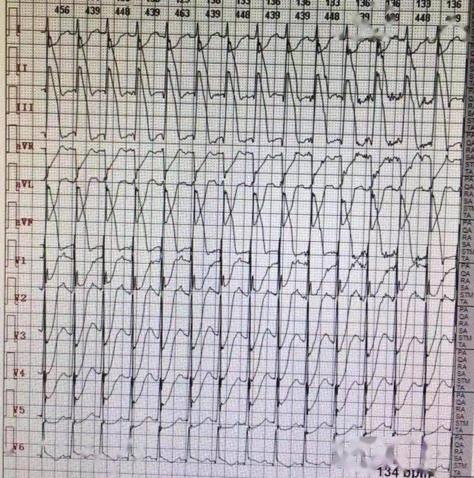除了62这8种心电图也提示心梗危重