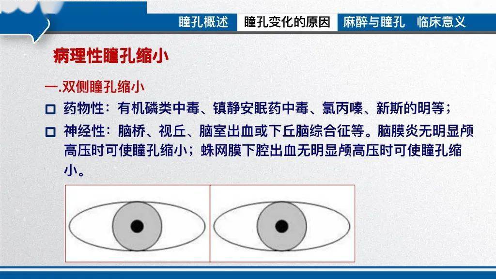 人虛驚一場的瞳孔散大——圍術期瞳孔變化及臨床意義_麻醉_直徑_大小