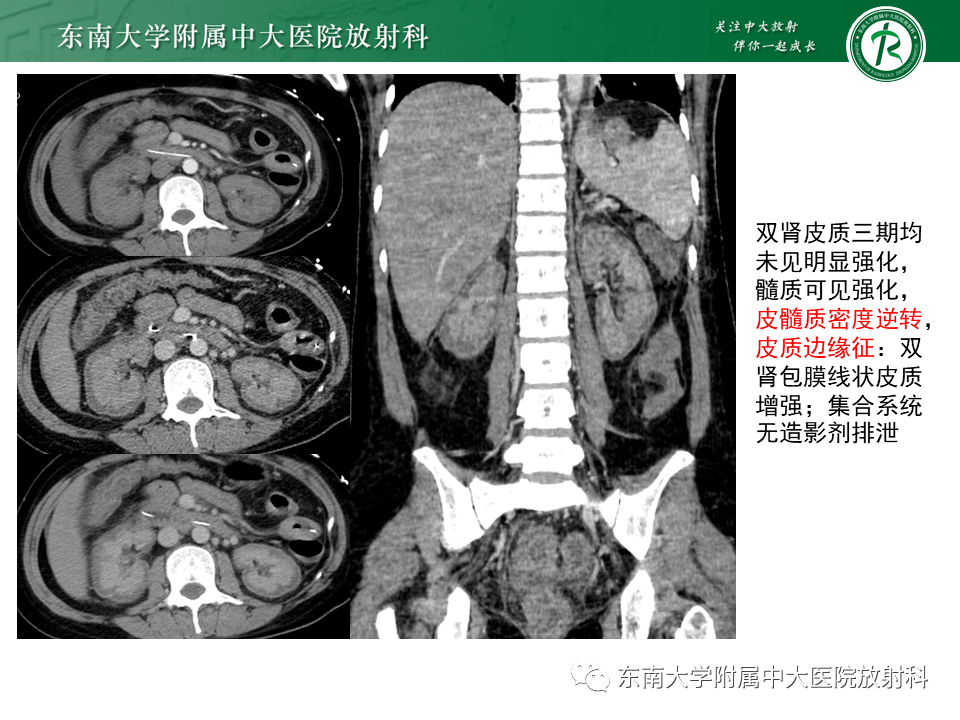 髓质海绵肾CT图片