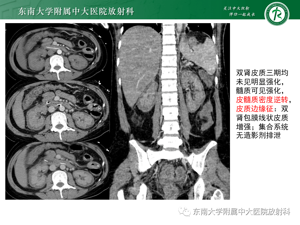 海绵肾影像图片