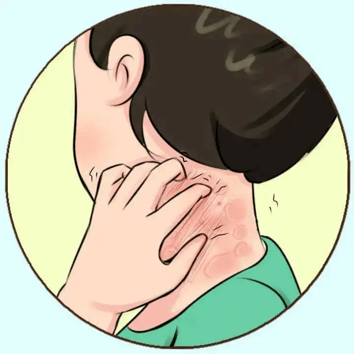什么是过敏原检查?有什么意义?_检测_抗原_过敏性