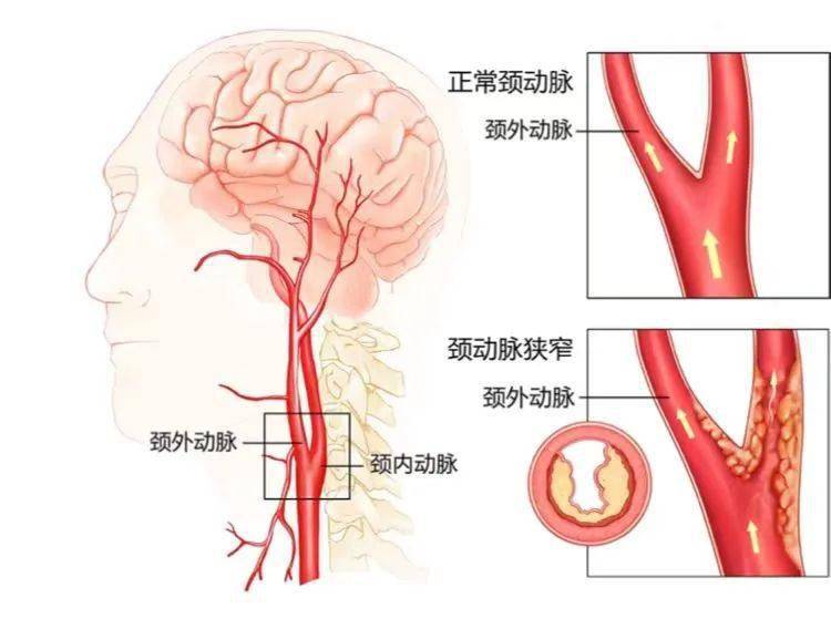 国家卫健委脑卒中防治委员会推荐:40岁以上人群应每年筛查颈动脉超声