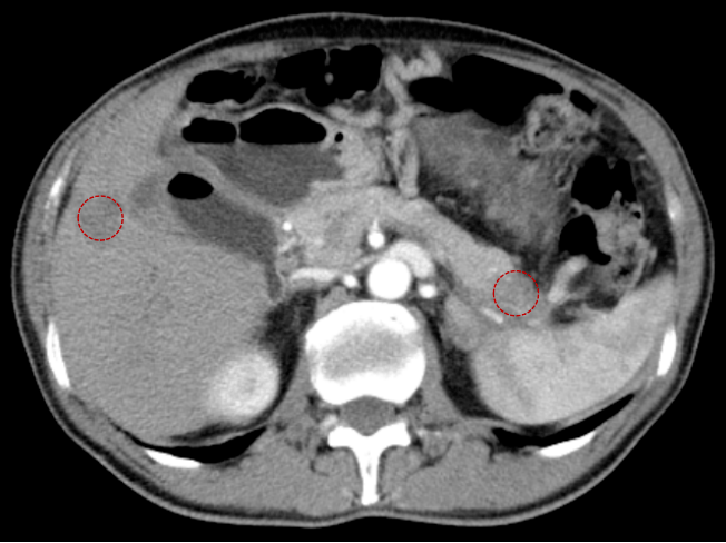 胰腺癌ct报告单图片图片