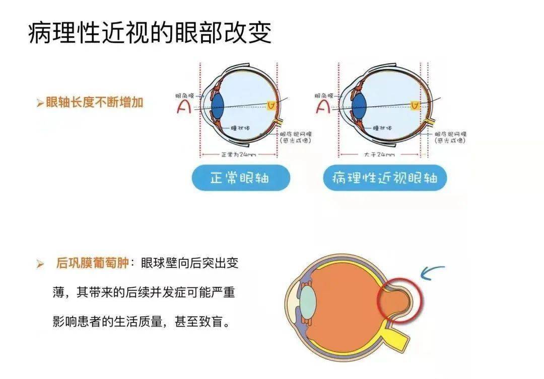为什么已经成年了,近视度数还在不断上涨!_眼睛_屈光度_进行性