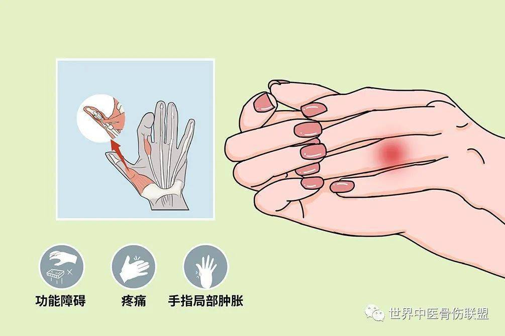 病因手指腱鞘炎是由于长期慢性劳损所导致的手指腱鞘炎症,主要是手指